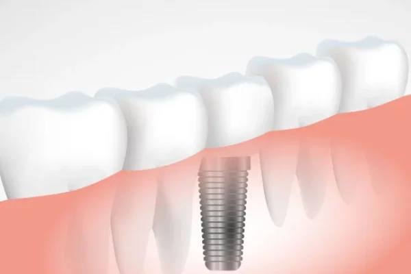 1-günde-implant-mümkünmü-
